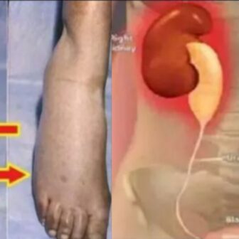 किड्नी फेल हुनभन्दा पहिला शरीरमा देखापर्छन् यी ३ संकेत