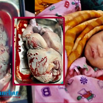 मोरङको रंगेली अस्पतालमा एउटी आमाले टाउको र मुटु नभएको बच्चा जन्माईन्