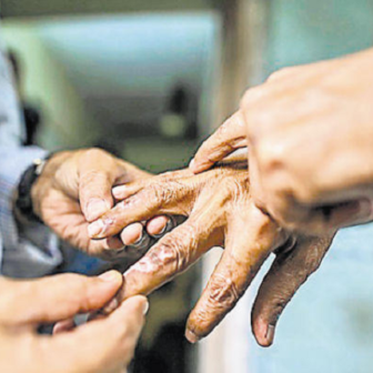 बाँकेमा कुष्ठरोगको बढ्दो असर, सामुदायिक सचेतना आवश्यक