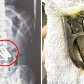 १५ वर्षीय बालकको पेटबाट सफल शल्यक्रियामार्फत कैंची निकालियो